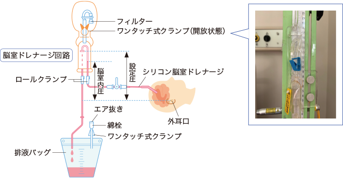 脳室ドレナージ内のクランプを表した図