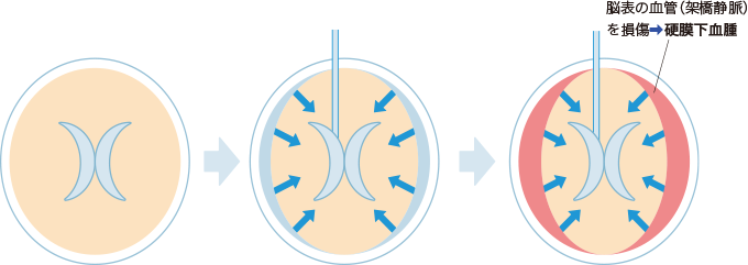 硬膜下血腫への進行を表す図