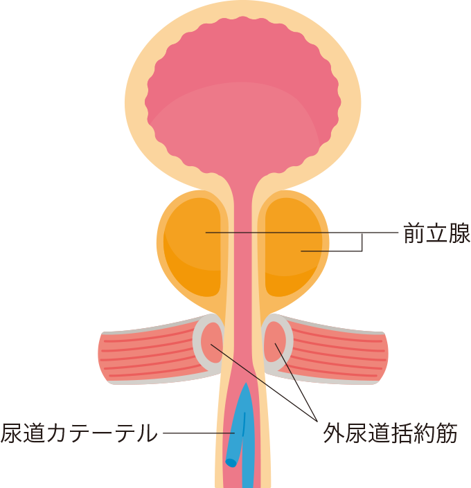 尿道カテーテルが挿入されているところを表した図