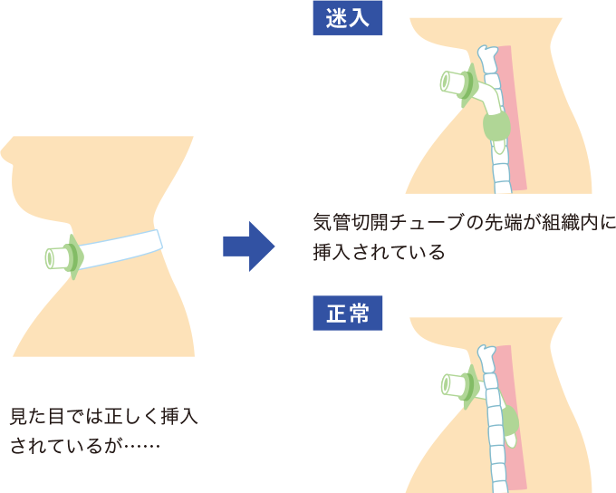 気管カニューレ皮下迷入を表したイラスト