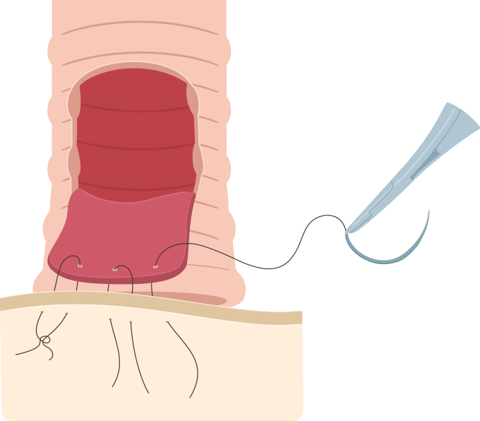 逆U字切開法を示したイラスト