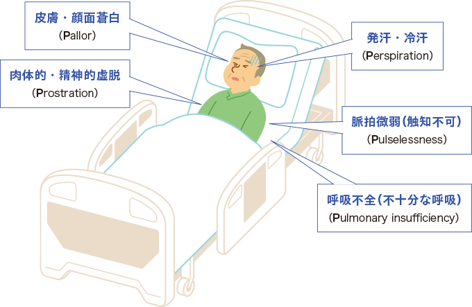ショックの5P徴候を表した図
