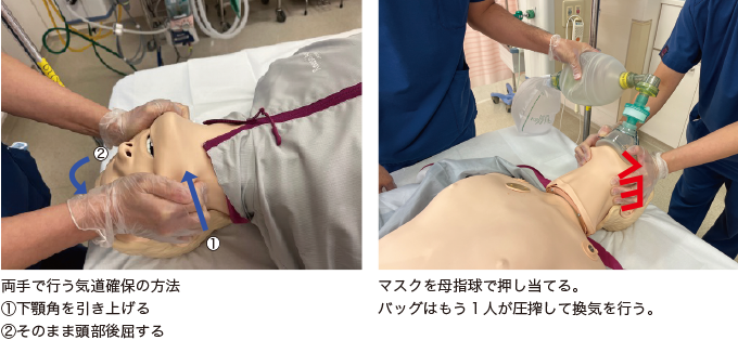 母指球法（VE法）を表した写真