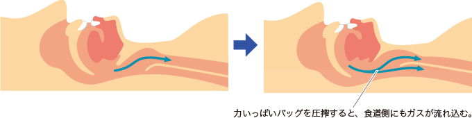 圧搾しすぎると気道内圧が上がりすぎて食道へ送気してしまう様子を表した図