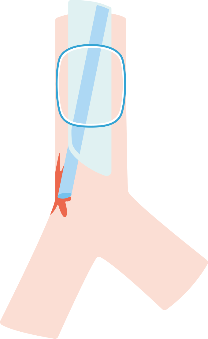 気管粘膜損傷を表したイラスト