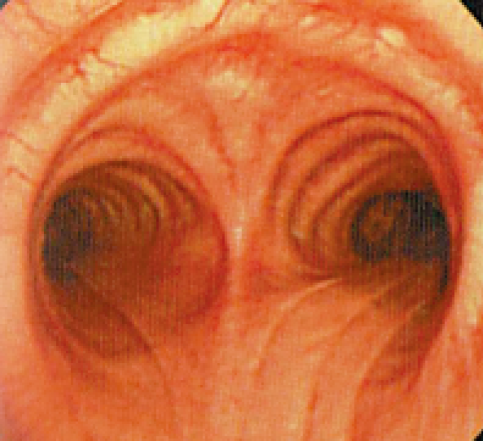 気管支鏡検査画像(気管分岐部)