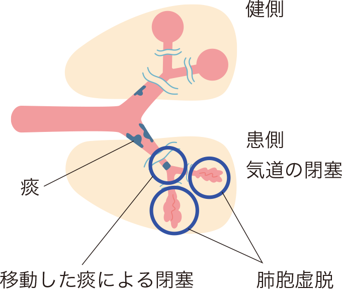 痰による気道の閉塞イメージ
