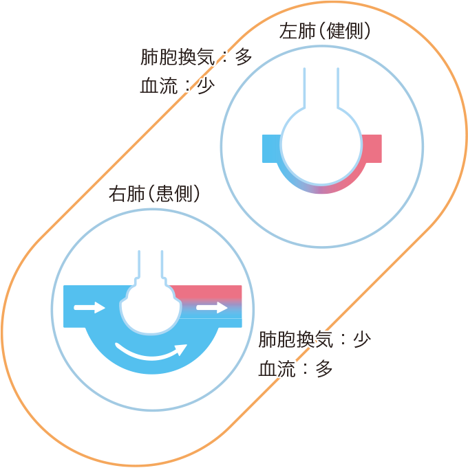 換気血流ミスマッチのイメージ（右側臥位）
