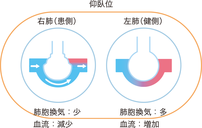 仰臥位での換気血流ミスマッチ改善のイメージ