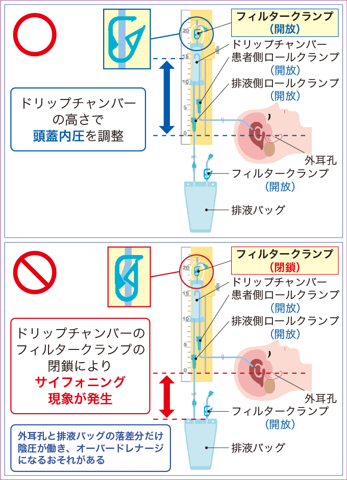 脳室ドレナージの仕組みとオーバードレナージを表した図