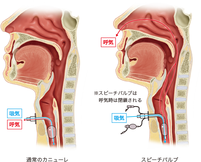 スピーチバルブの構造を表した図