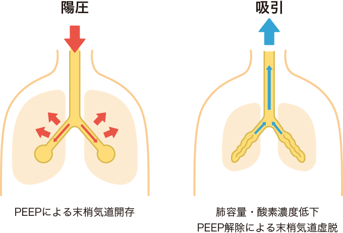 吸引による肺容量・酸素濃度低下、末梢気道虚脱のイメージの図