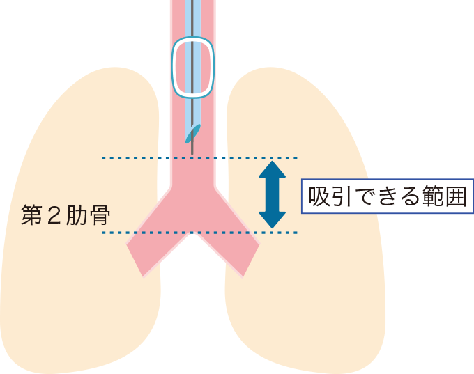 痰を吸引できる範囲と肋骨の関係を表した図