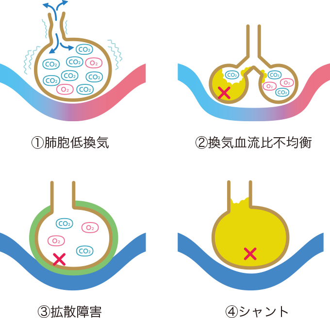 低酸素血症の4つの原因を表した図