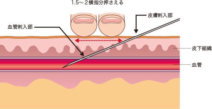 血管刺入部と皮膚刺入部の位置関係を表した図