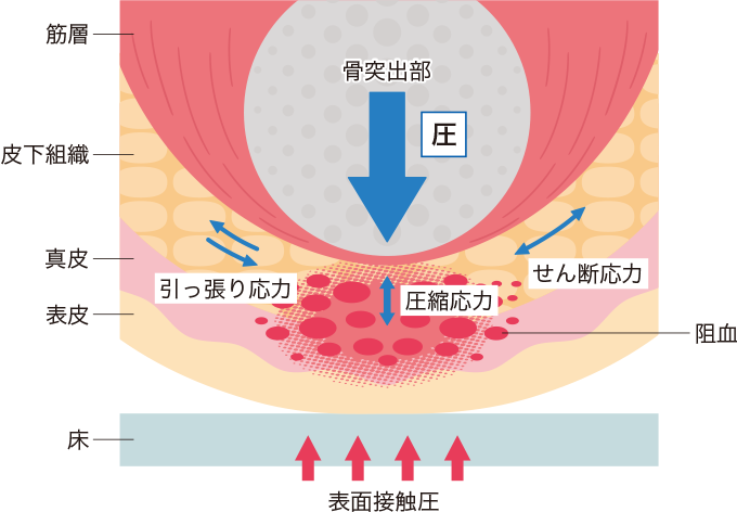 褥瘡発生のメカニズムを表した図