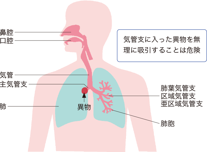 吸引チューブと気管の関係を表した図