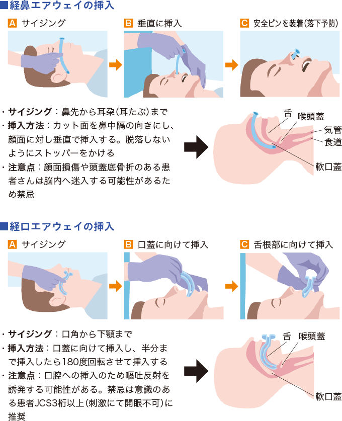 経口エアウェイと経鼻エアウェイの使用法をあらわした図