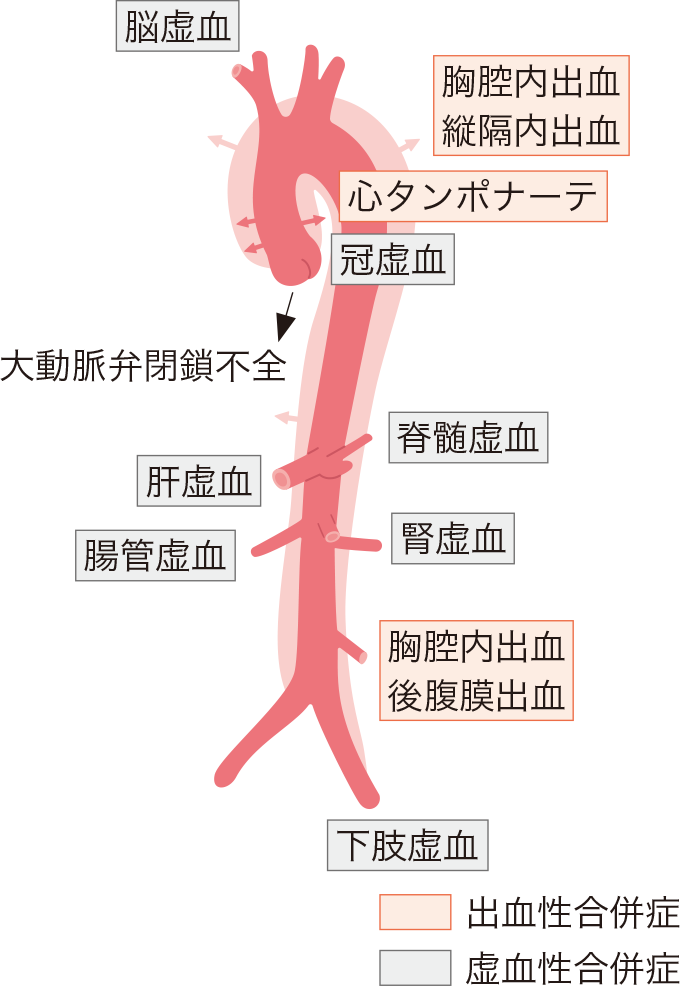 大動脈解離の部位による症状をあらわす図