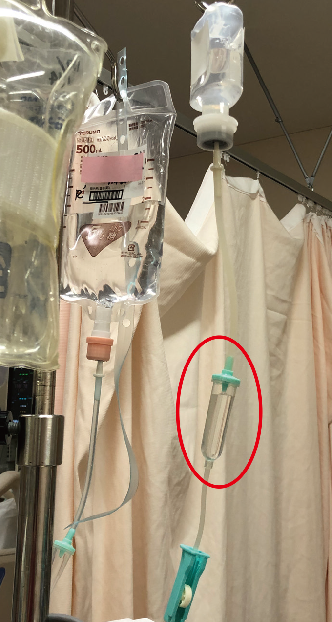 滴下せずに側管点滴ラインへ流入している例を示した写真