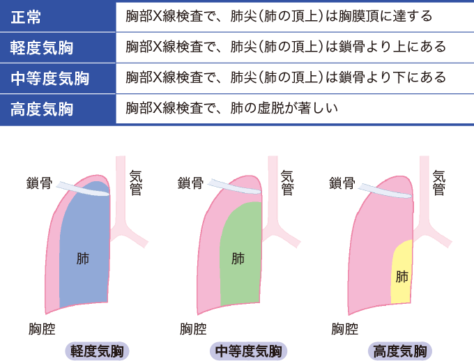 気胸の重症度をあらわした表
