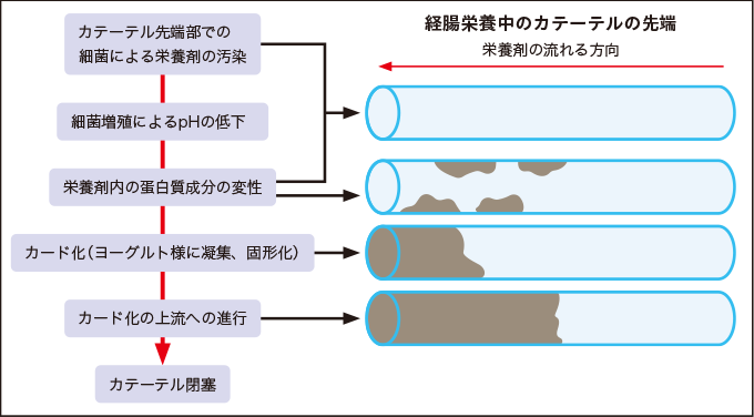 カード化によるチューブ閉塞の機序を表した図