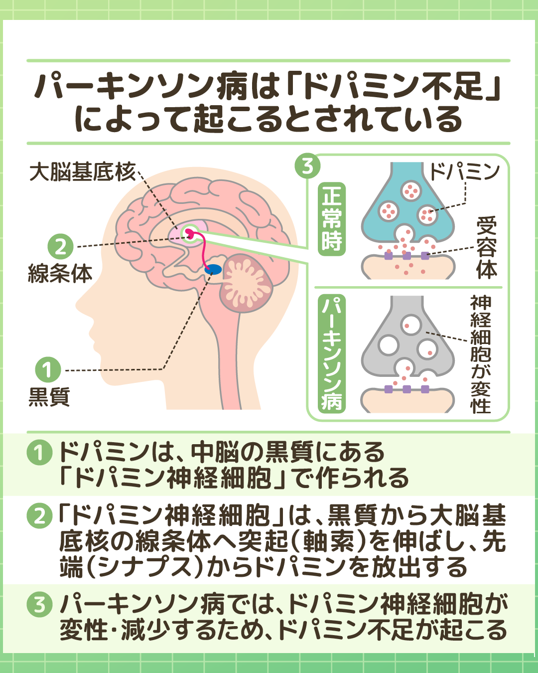 パーキンソン病の発生メカニズムを示す図。中脳の黒質で作られるドパミンが、ドパミン神経細胞の変性により不足する仕組みを脳のイラストと正常時・病状時の比較で解説している。