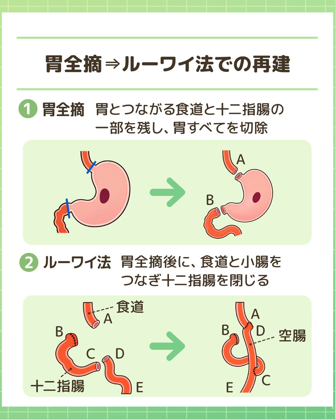 胃全摘とルーワイ法での再建。①胃と繋がる食道と十二指腸の一部を残して胃をすべて切除する流れ、②食道と小腸をつなぎ十二指腸を閉じる構造イラスト。