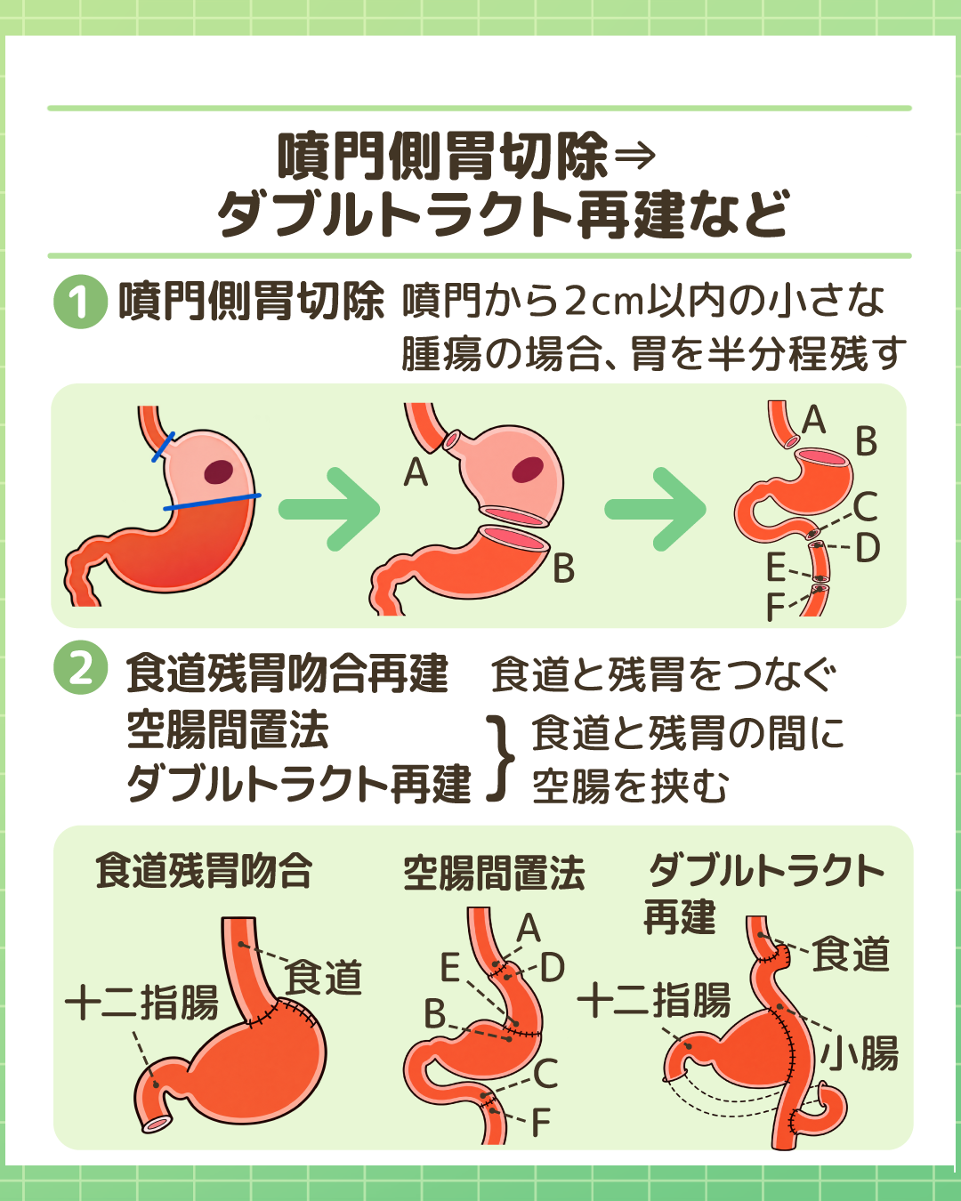 噴門側胃切除と再建術。①噴門側胃切除の解説、②食道残胃吻合、空腸間置法、ダブルトラクト再建など食道と残胃・空腸をつなぐ各種再建法の構造イラスト。