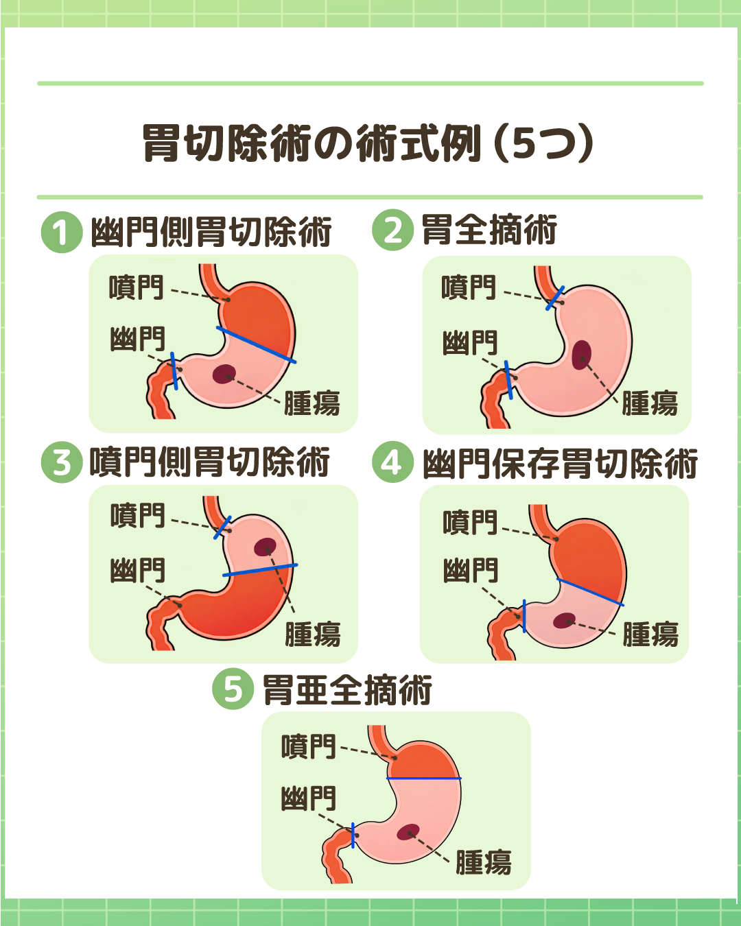 胃切除術の術式例（5つ）。①幽門側胃切除術、②胃全摘術、③噴門側胃切除術、④幽門保存胃切除術、⑤胃亜全摘術の切除部位を示したイラスト。