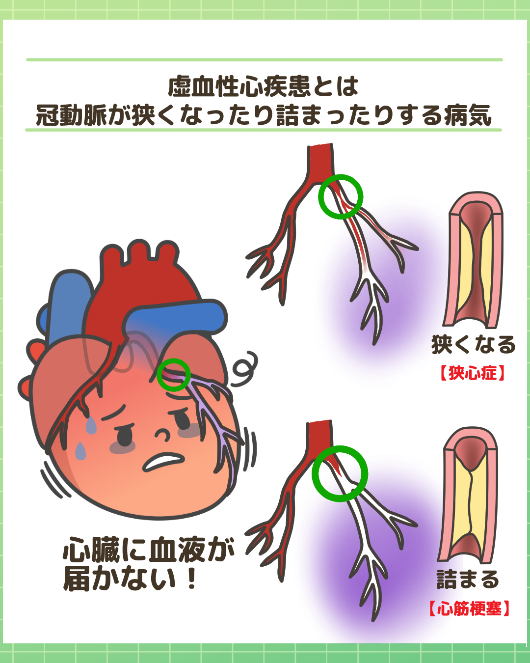 虚血性心疾患（狭心症と心筋梗塞）の違いを冠動脈の図で解説したイラスト