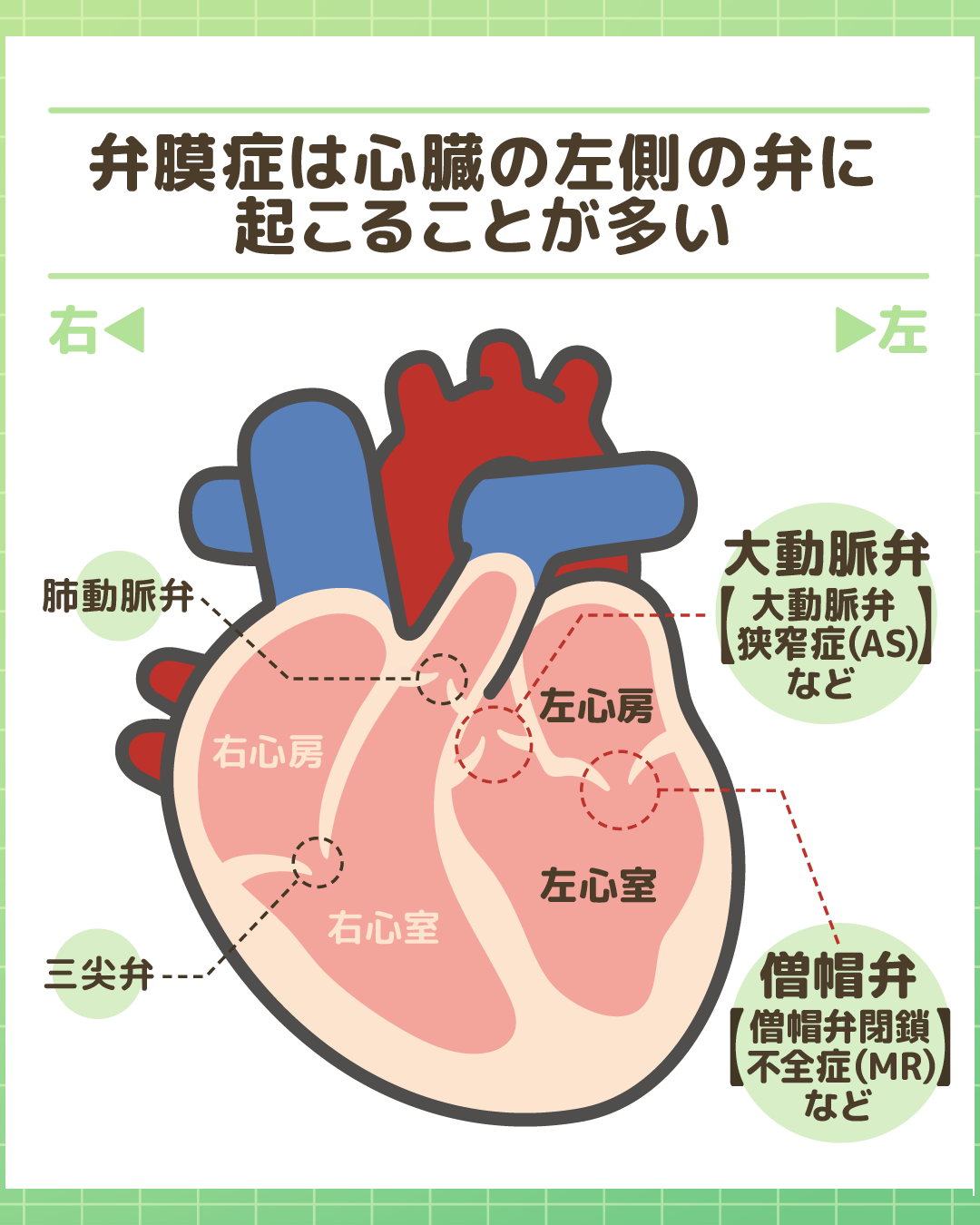 弁膜症（大動脈弁狭窄症・僧帽弁閉鎖不全症など）が起こりやすい心臓の部位解説図