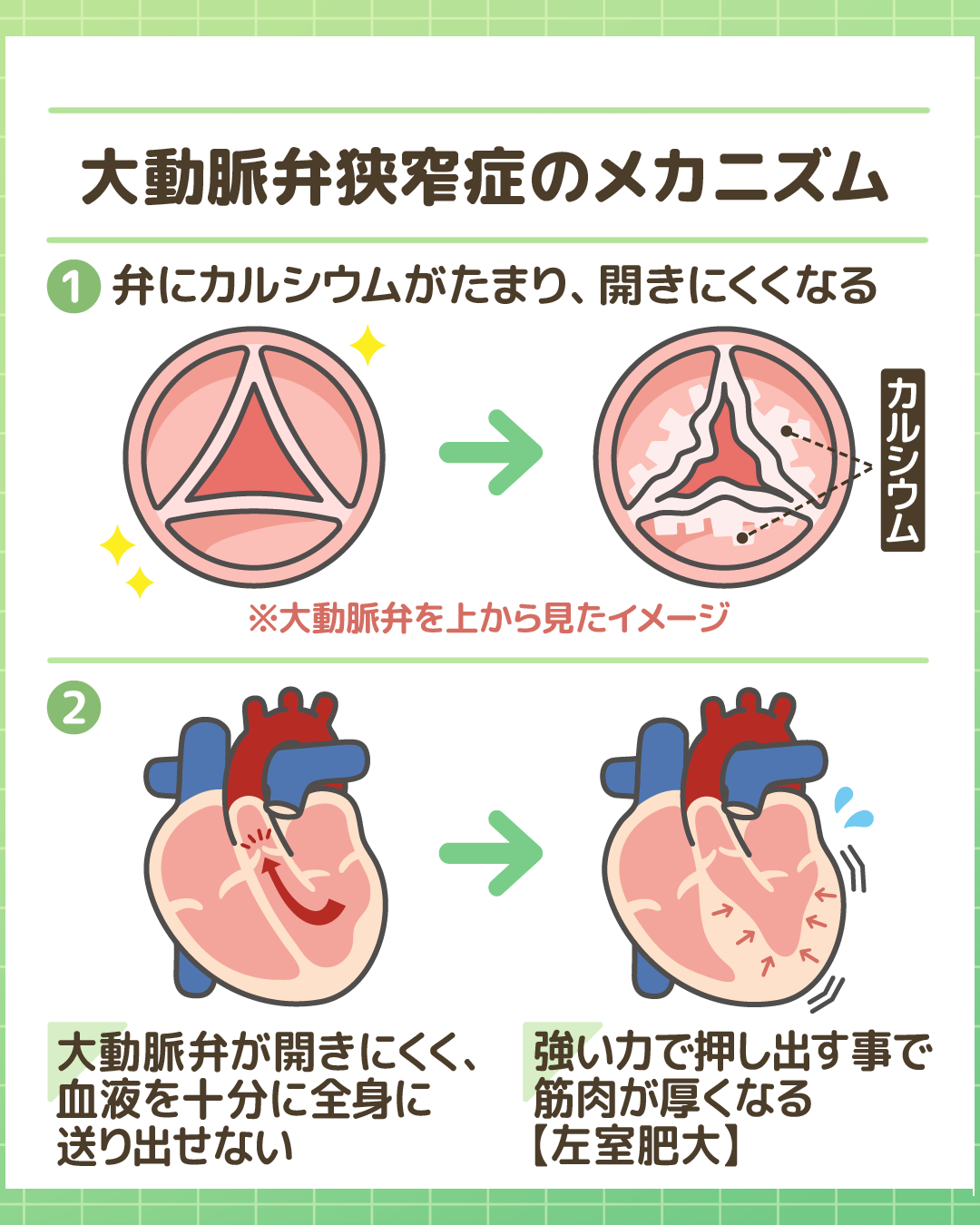 大動脈弁狭窄症のメカニズム：弁の石灰化と左室肥大の図解