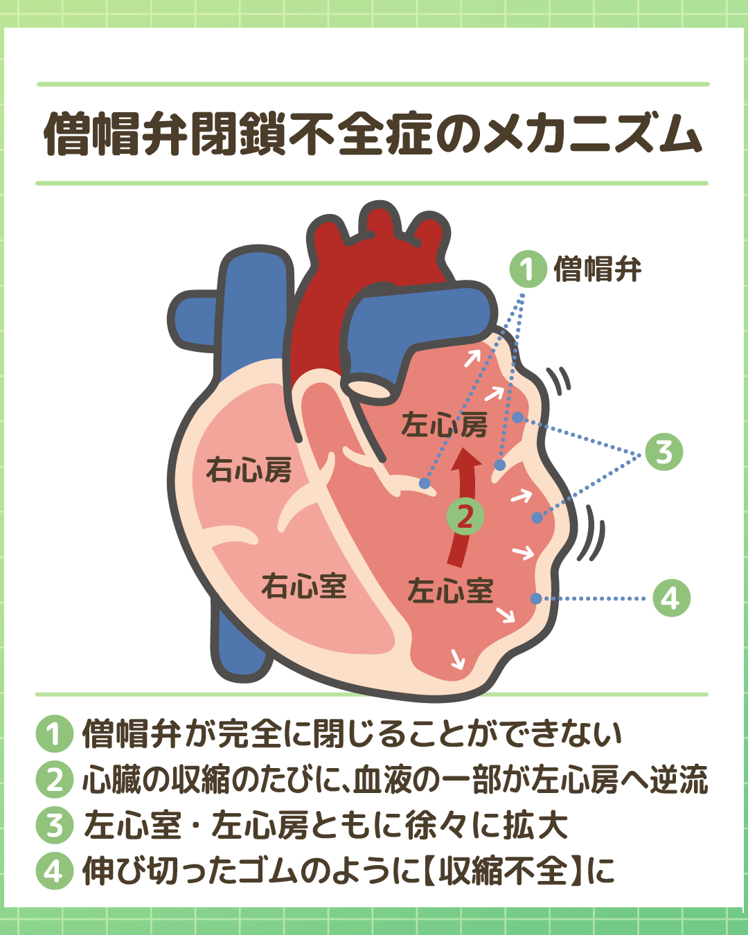 僧帽弁閉鎖不全症のメカニズム：血液の逆流と心拡大、収縮不全の図解
