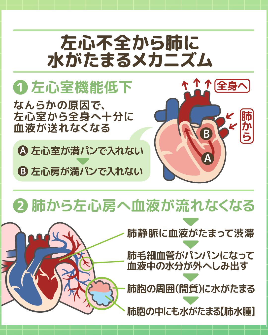 左心不全から肺水腫（肺に水がたまる）に至るメカニズムの図解