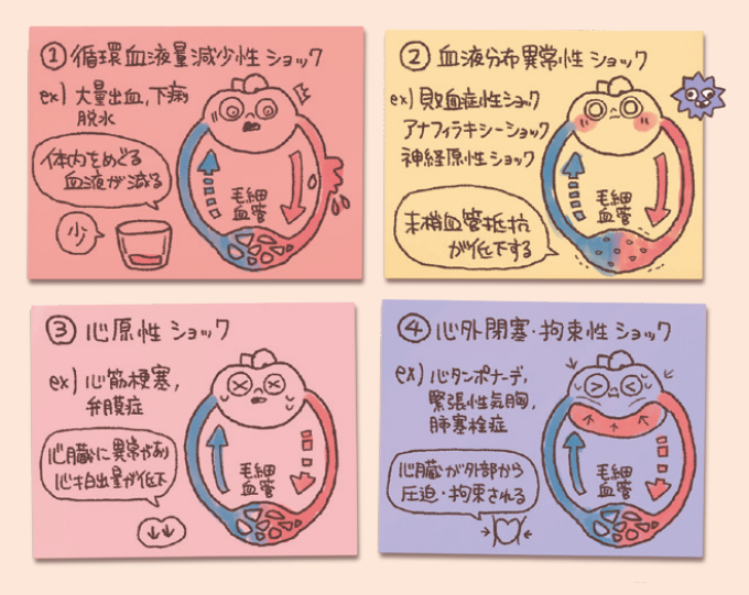 4種類のショックの画像