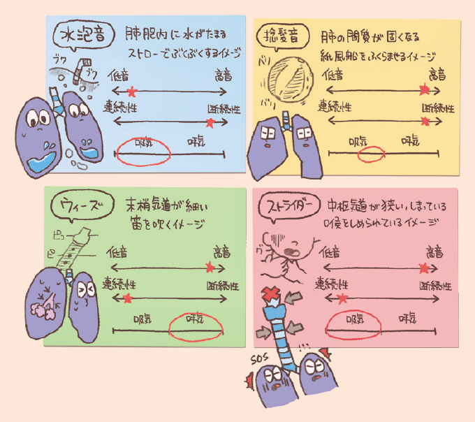 4種類の副雑音(水泡音、捻髪音、ウィーズ、ストライダー)の特徴をまとめた図解。 1.水泡音(青):肺胞内に水がたまる状態で「ストローでぶくぶくするイメージ」。音の高さは中低音、性質は断続性、吸気時に聴こえる。 2.捻髪音(黄):肺の間質が固くなる状態で「紙風船をふくらませるイメージ」。音の高さは高音、性質は断続性、吸気終末に聴こえる。 3.ウィーズ(緑):末梢気道が細い状態で「笛を吹くイメージ」。音の高さは高音、性質は連続性、呼気時に聴こえる。 4.ストライダー(赤):中枢気道が狭い状態で「のどをしめられているイメージ」。音の高さは高音、性質は連続性、吸気時に聴こえる。 各項目には、音の高さ・連続性/断続性・吸気/呼気のタイミングを示す評価スケールとイメージイラストが添えられています。