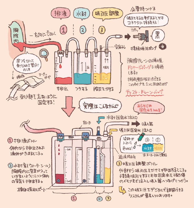 胸腔ドレーンバッグの仕組みと3層ボトルの構造を説明する図解。上部には「(1)排液(排出する)」「(2)水封(フタする)」「(3)吸引圧調整(陰圧をかける)」の3つの役割が示され、胸腔内から一方向に液体が流れる仕組みが描かれています。下部には、これらを一体化した「チェスト・ドレーン・バッグ」の具体的な構造が示され、(1)体内の液体がたまる排液ボトル、(2)空気の逆流を防ぐ水封室(ウォーターシール)、(3)外部から吸引圧をかける吸引圧調整ボトルの各機能と、固定水の注入、検体採取ポート、吸引器への接続方法が詳しく解説されています。