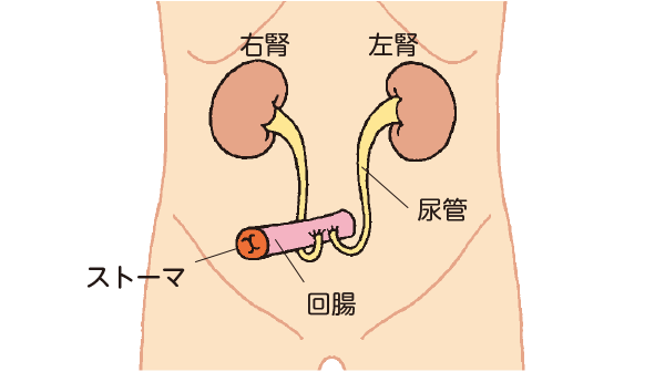 高出力ストーマの原因は何ですか?