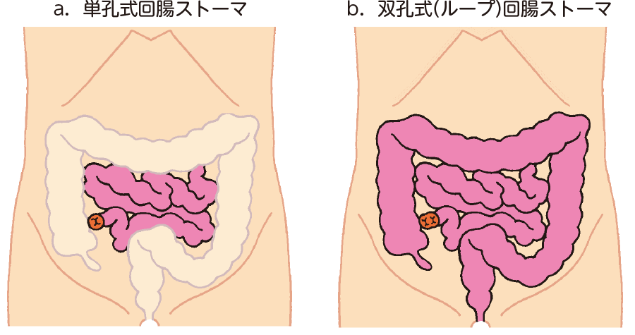 回腸瘻バッグの手入れ方法