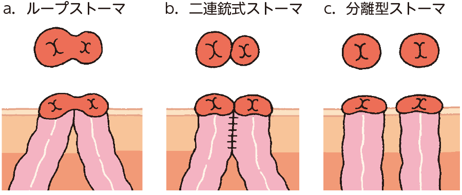 ループ回腸瘻の準備