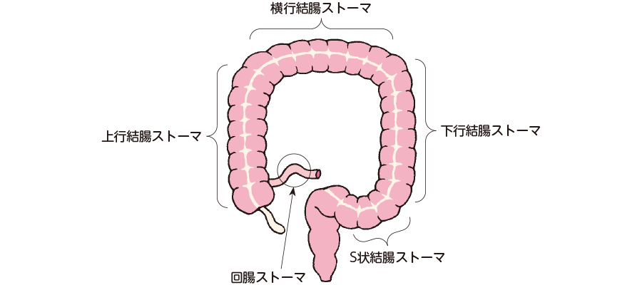 高出力ストーマを管理するにはどうすればよいですか?