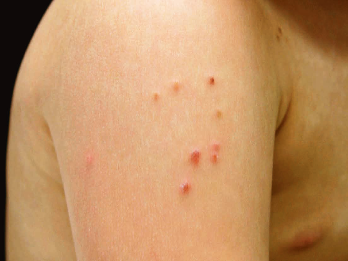 結節性痒疹の症状