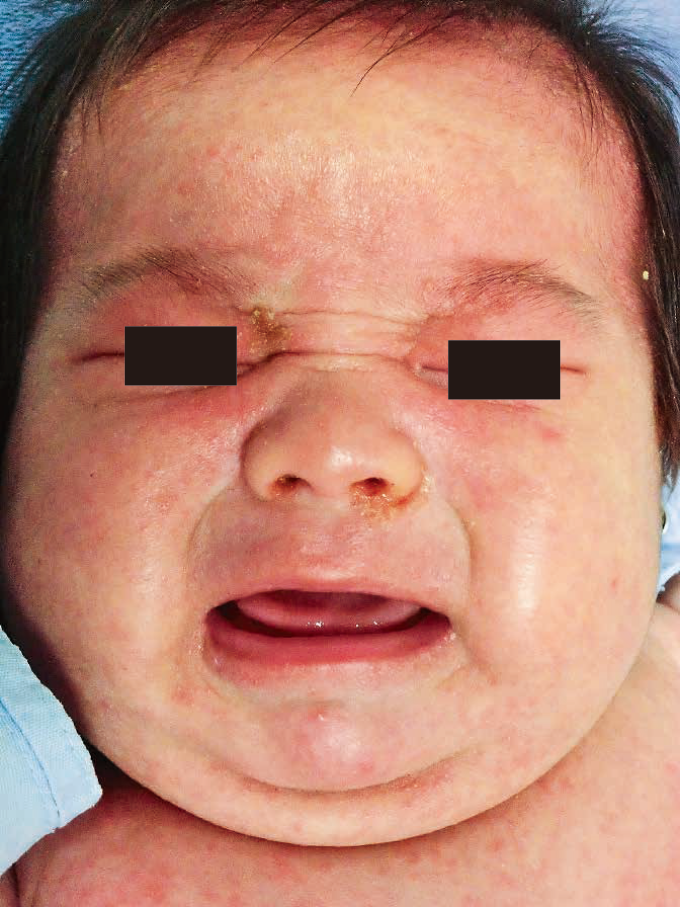 Tss Staphylococcal Scalded Skin Syndrome RZDNZ