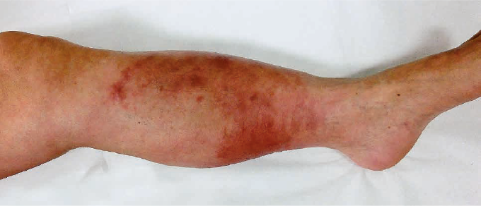 鼠径部の蜂窩織炎の原因は何ですか?