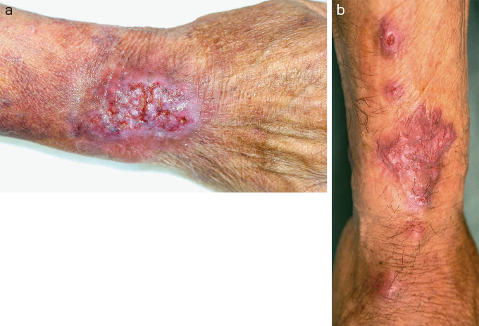 表在性黒色腫の治療法は何ですか?