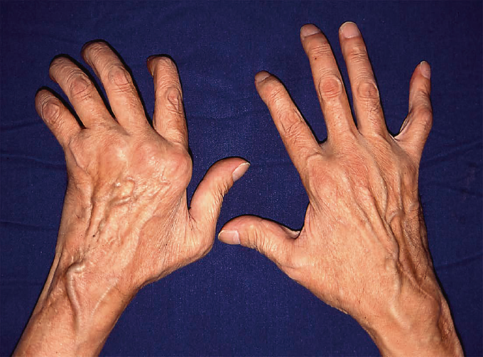 痛風の初期症状