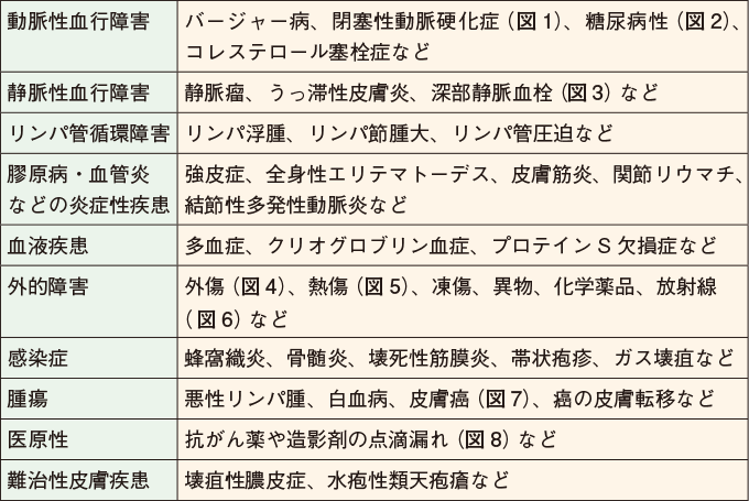神経障害性皮膚潰瘍