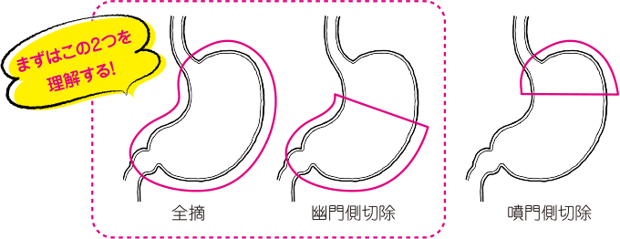 胃切除術が必要になる理由