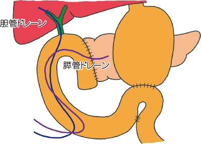 膵臓切除術の手順